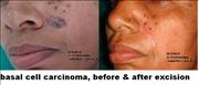 Before After Pictures,Delhi,skin cancer bcc 